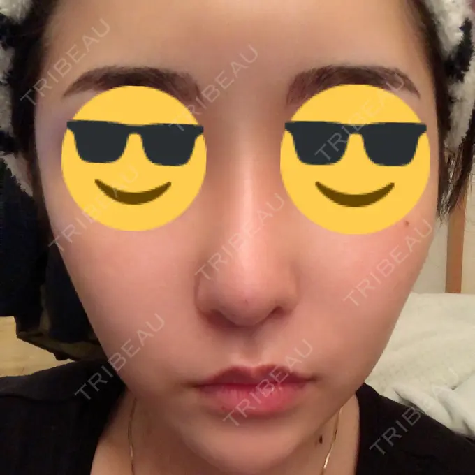 隆鼻術 / 軟骨移植 / 骨切幅寄せ / 鼻尖縮小 / その他（鼻） 韓国BBクリニック（旧 シンミアン形成外科） DAY 75 メイン用