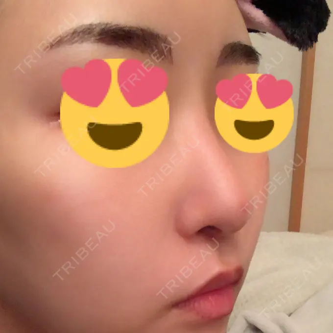 隆鼻術 / 軟骨移植 / 骨切幅寄せ / 鼻尖縮小 / その他（鼻） 韓国BBクリニック（旧 シンミアン形成外科） DAY 75 メイン用