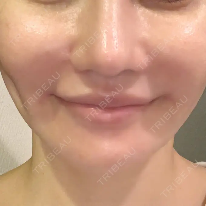 口角挙上 現代美学整形外科 DAY 24 メイン用