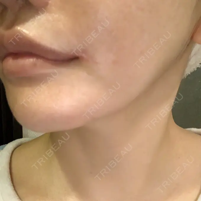 口角挙上 現代美学整形外科 DAY 24 メイン用