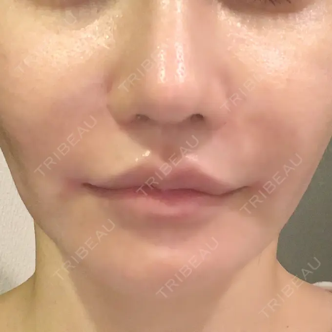 口角挙上 現代美学整形外科 DAY 24 メイン用