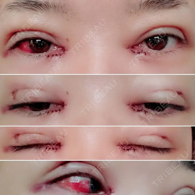 二重埋没 / 目頭切開 / その他 湘南美容クリニック 京都院 DAY 2 メイン用