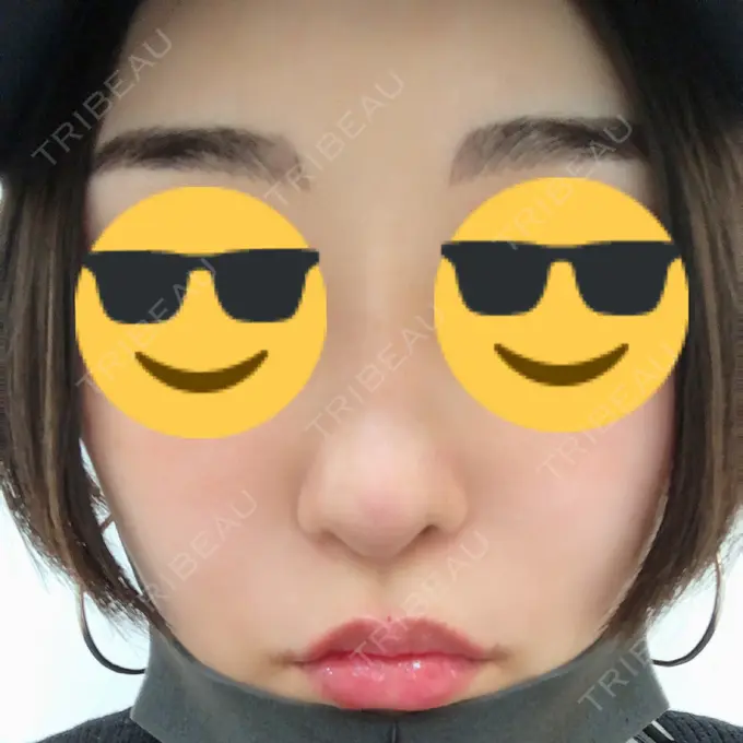 隆鼻術 / 軟骨移植 / 骨切幅寄せ / 鼻尖縮小 / その他（鼻） 韓国BBクリニック（旧 シンミアン形成外科） DAY 77 メイン用