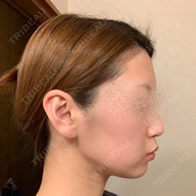 ボトックス（エラ・小顔） / ピーリング（ニキビ・毛穴） 湘南美容クリニック 大阪梅田本院 DAY 36 メイン用