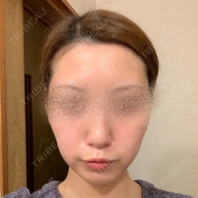 ボトックス（エラ・小顔） / ピーリング（ニキビ・毛穴） 湘南美容クリニック 大阪梅田本院 DAY 36 メイン用