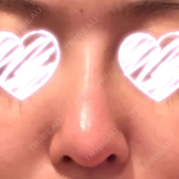 隆鼻術 / 軟骨移植 みずほクリニック DAY 14 メイン用