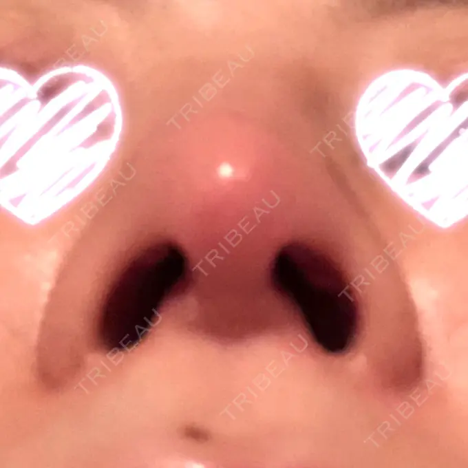 隆鼻術 / 軟骨移植 みずほクリニック DAY 14 メイン用