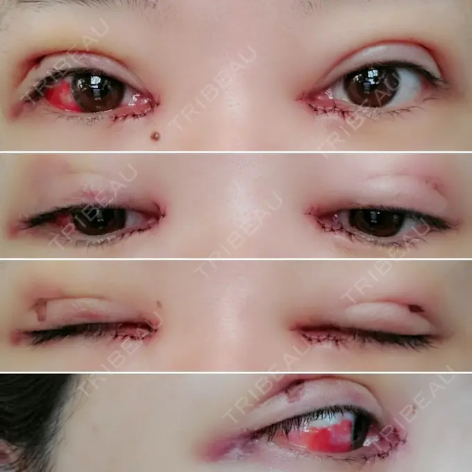 二重埋没 / 目頭切開 / その他 湘南美容クリニック 京都院 DAY 3 メイン用