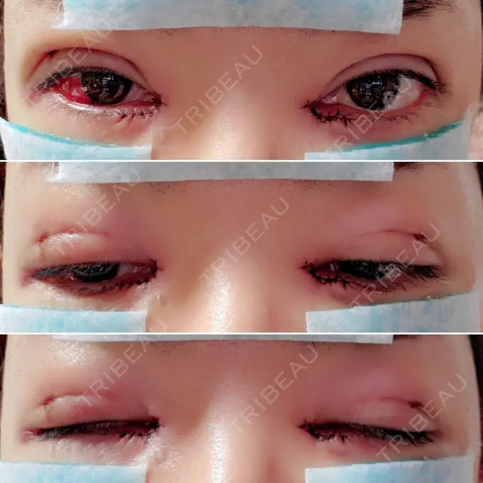 二重埋没 / 目頭切開 / その他 湘南美容クリニック 京都院 DAY 3 メイン用