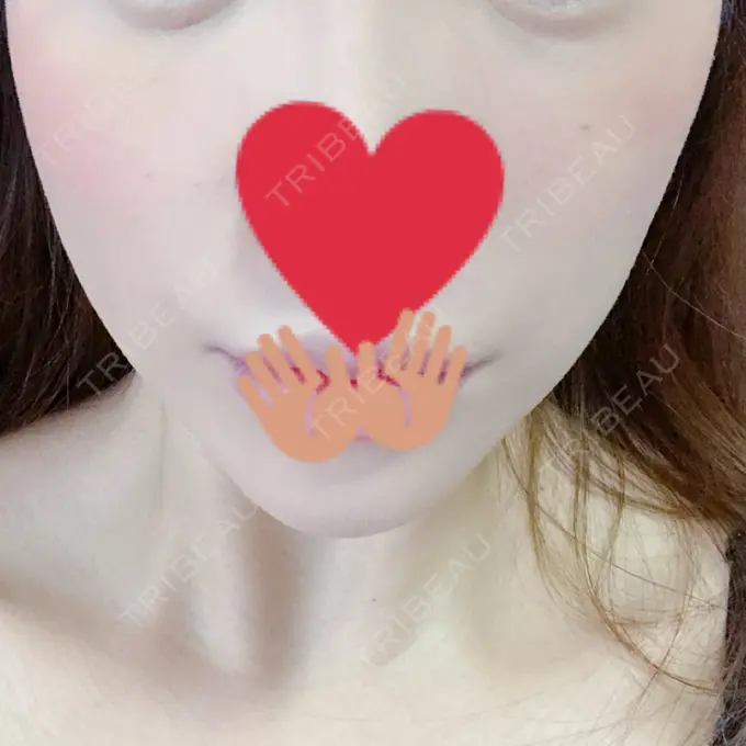 ハイフ（顔） リエンジャン整形外科 江南店 AFTER メイン用