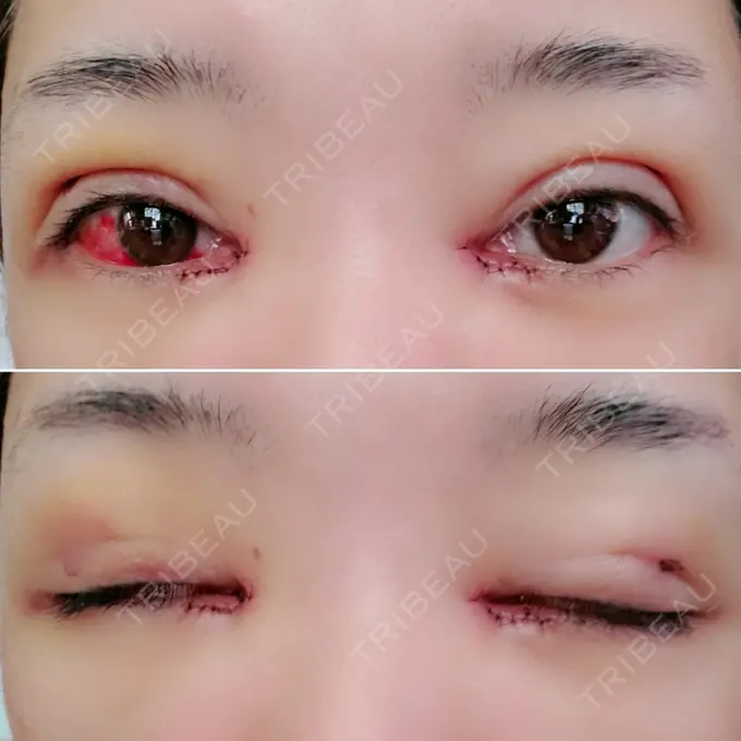 二重埋没 / 目頭切開 / その他 湘南美容クリニック 京都院 DAY 4 メイン用