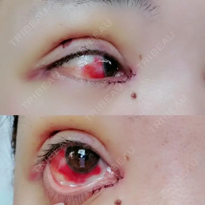 二重埋没 / 目頭切開 / その他 湘南美容クリニック 京都院 DAY 4 メイン用