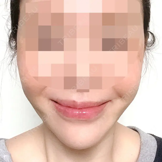 骨切り（あご） / 骨削り（エラ） / 骨削り（頬） シンデレラ美容整形外科 AFTER メイン用