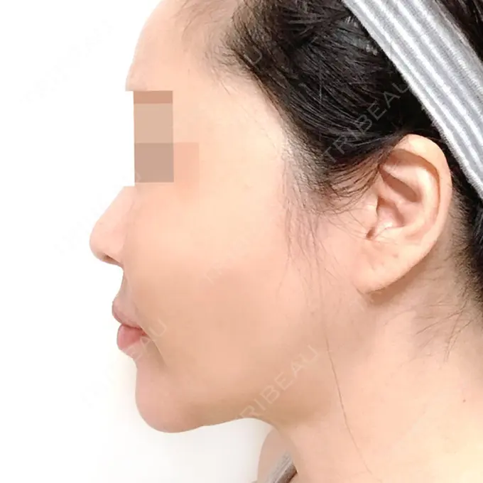 骨切り（あご） / 骨削り（エラ） / 骨削り（頬） シンデレラ美容整形外科 DAY 202 メイン用