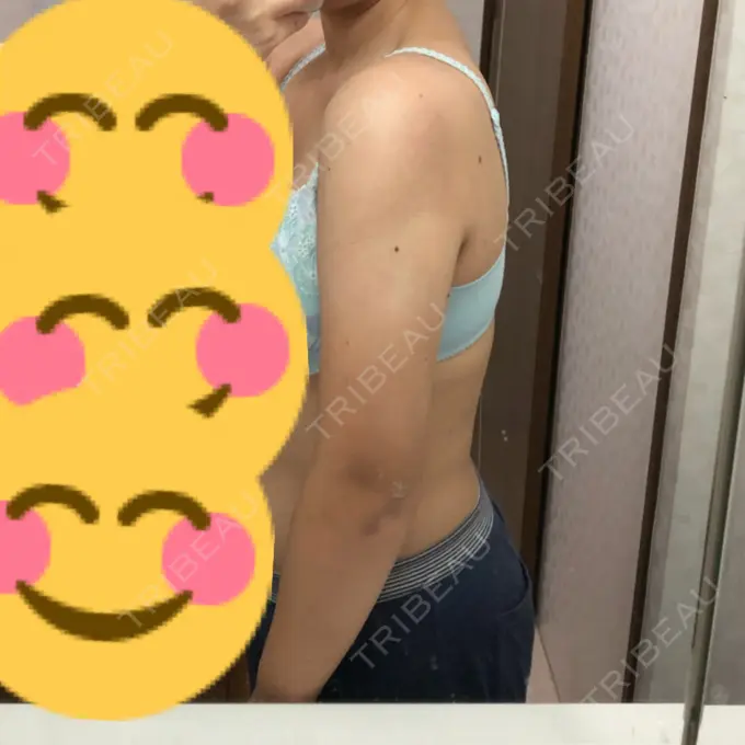 脂肪吸引（二の腕） 湘南美容クリニック 岡山院 DAY 53 メイン用