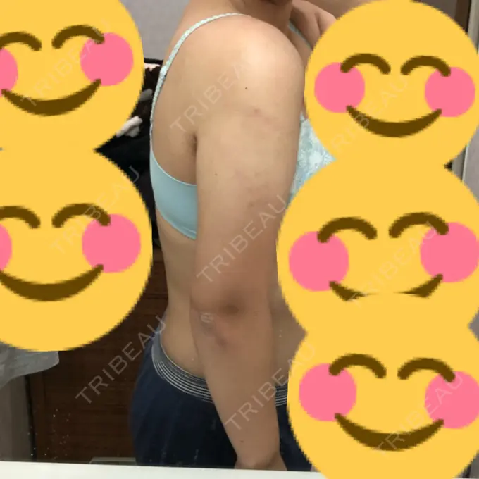 脂肪吸引（二の腕） 湘南美容クリニック 岡山院 DAY 53 メイン用