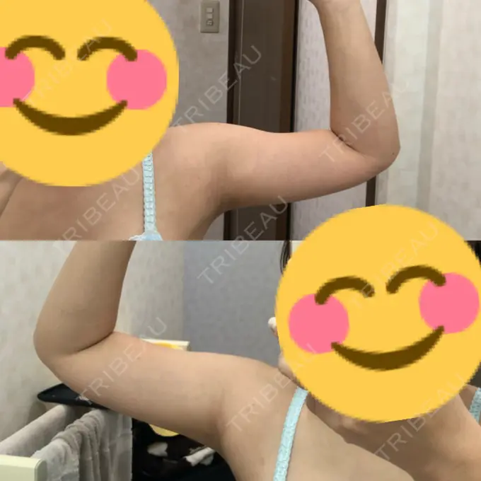 脂肪吸引（二の腕） 湘南美容クリニック 岡山院 DAY 53 メイン用