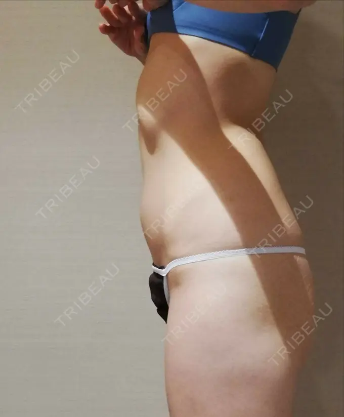 脂肪吸引（お腹） / 脂肪溶解注射（お腹） UB CLINIC銀座 DAY 28 メイン用