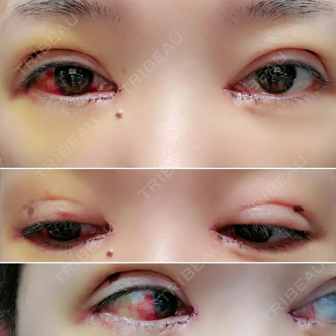 二重埋没 / 目頭切開 / その他 湘南美容クリニック 京都院 DAY 5 メイン用