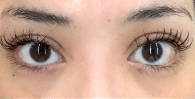 二重切開 / 目頭切開 城本クリニック 福岡院 DAY 88 メイン用