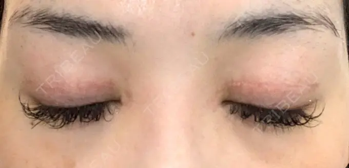 二重切開 / 目頭切開 城本クリニック 福岡院 DAY 88 メイン用