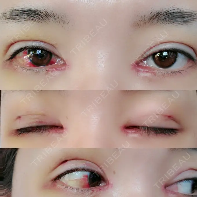 二重埋没 / 目頭切開 / その他 湘南美容クリニック 京都院 DAY 6 メイン用