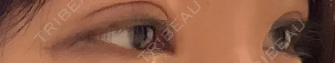 二重埋没 湘南美容クリニック 京都院 DAY 20 メイン用