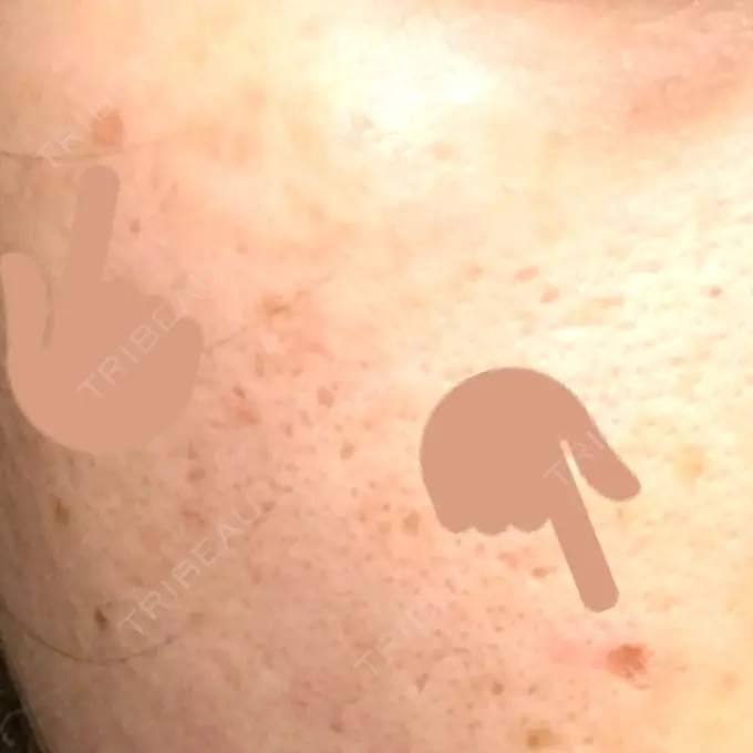 ほくろ・いぼ切除（肌） 金沢中央クリニック DAY 18 メイン用