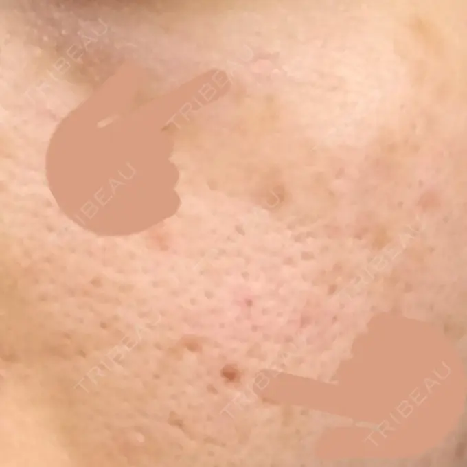 ほくろ・いぼ切除（肌） 金沢中央クリニック DAY 18 メイン用