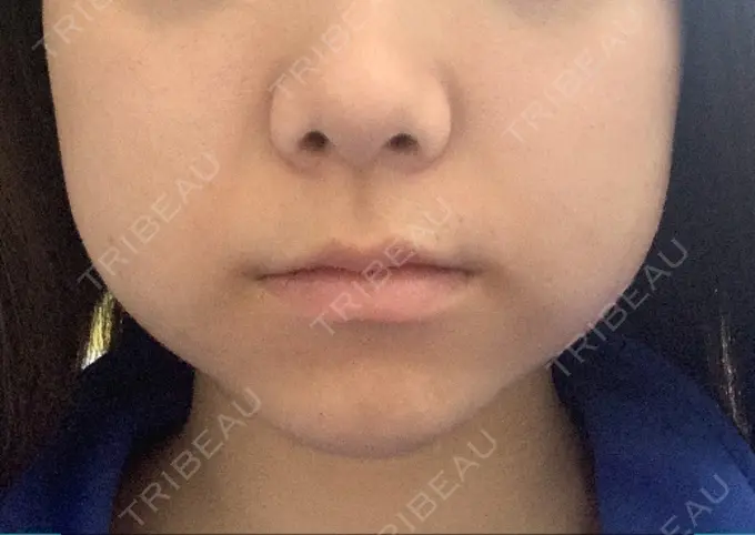 ボトックス（エラ・小顔） / 脂肪溶解注射（顔） ビクアスクリニック DAY 4 メイン用