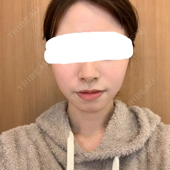 脂肪溶解注射（顔） 赤坂プレミアクリニック DAY 12 メイン用