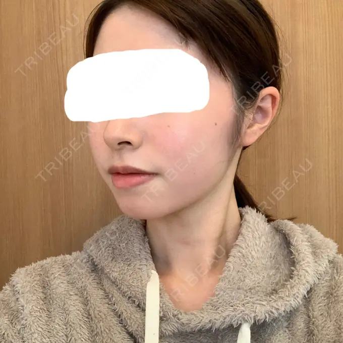 脂肪溶解注射（顔） 赤坂プレミアクリニック DAY 12 メイン用