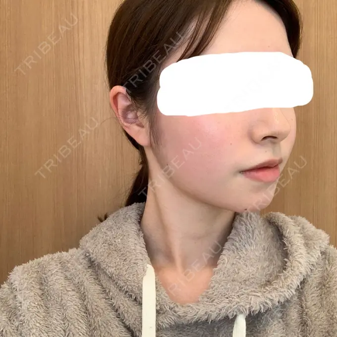 脂肪溶解注射（顔） 赤坂プレミアクリニック DAY 12 メイン用