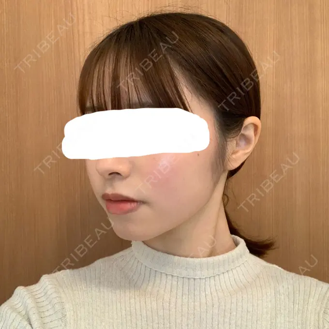 脂肪溶解注射（顔） 赤坂プレミアクリニック DAY 13 メイン用