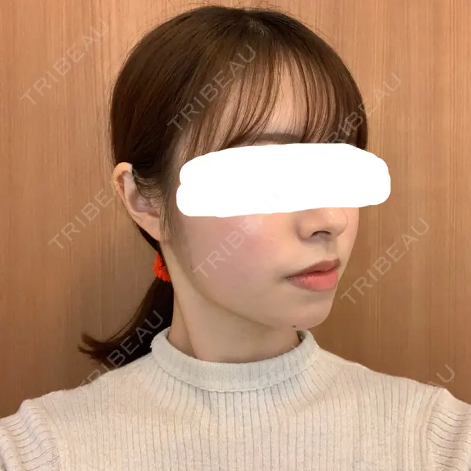 脂肪溶解注射（顔） 赤坂プレミアクリニック DAY 13 メイン用