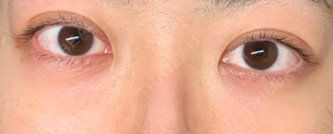 二重埋没 東京イセアクリニック DAY 9 メイン用