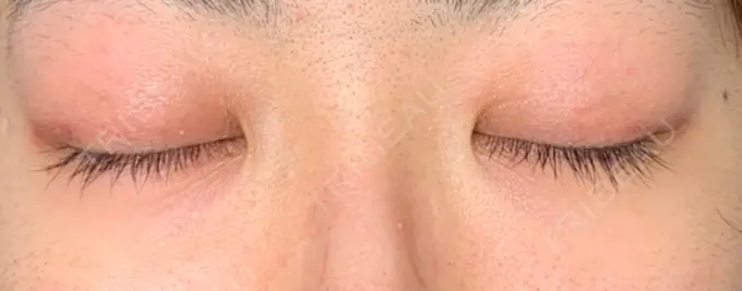 二重埋没 東京イセアクリニック DAY 9 メイン用