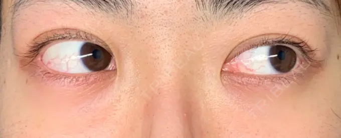 二重埋没 東京イセアクリニック DAY 9 メイン用