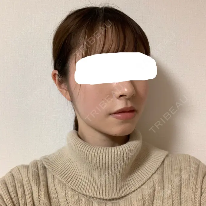 脂肪溶解注射（顔） 赤坂プレミアクリニック DAY 14 メイン用