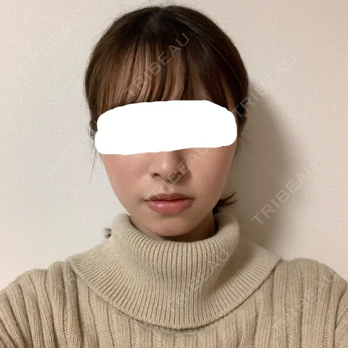 脂肪溶解注射（顔） 赤坂プレミアクリニック AFTER メイン用