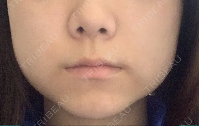 ボトックス（エラ・小顔） / 脂肪溶解注射（顔） ビクアスクリニック DAY 5 メイン用