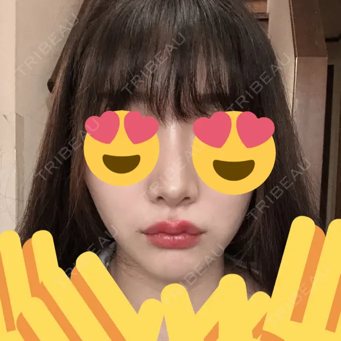 隆鼻術 / 鼻尖形成（切開） / 鼻中隔延長（切開） / 小鼻縮小（切開） / プロテーゼ除去 / 鼻尖縮小 FROM B整形外科 (旧バウム整形外科) DAY 373 メイン用