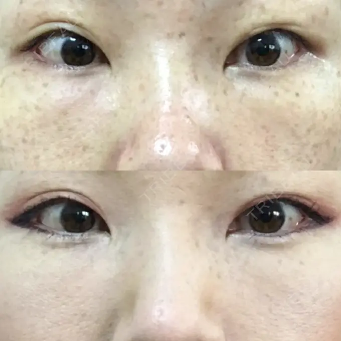 下まぶたたるみ取り / 下まぶたの脂肪取り 韓国ST美容整形外科 DAY 176 メイン用