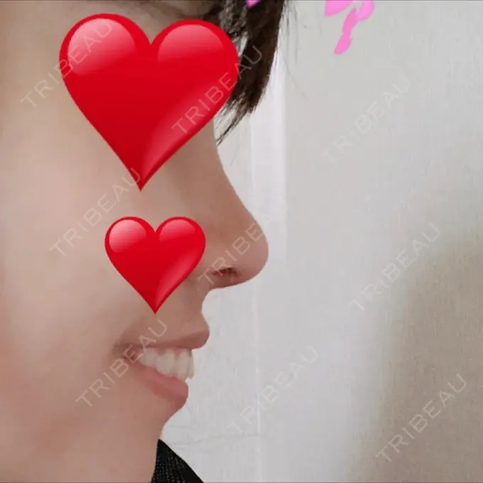 隆鼻術 / 鼻尖形成（切開） / 鼻中隔延長（切開） / 眉間プロテーゼ FROM B整形外科 (旧バウム整形外科) DAY 14 メイン用