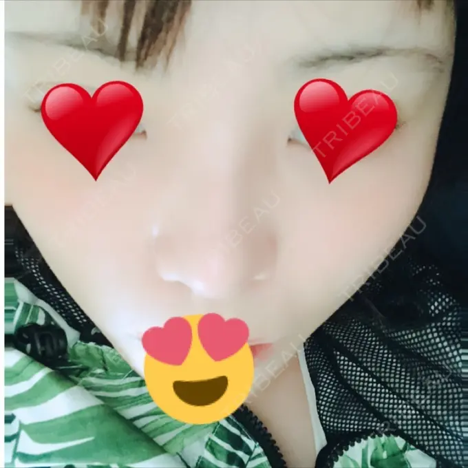 隆鼻術 / 鼻尖形成（切開） / 鼻中隔延長（切開） / 眉間プロテーゼ FROM B整形外科 (旧バウム整形外科) DAY 14 メイン用