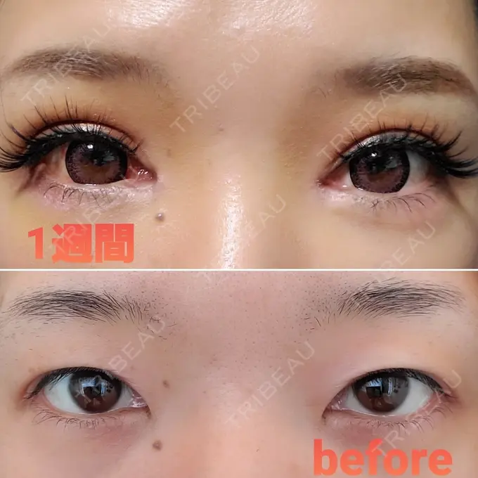 二重埋没 / 目頭切開 / その他 湘南美容クリニック 京都院 DAY 8 メイン用