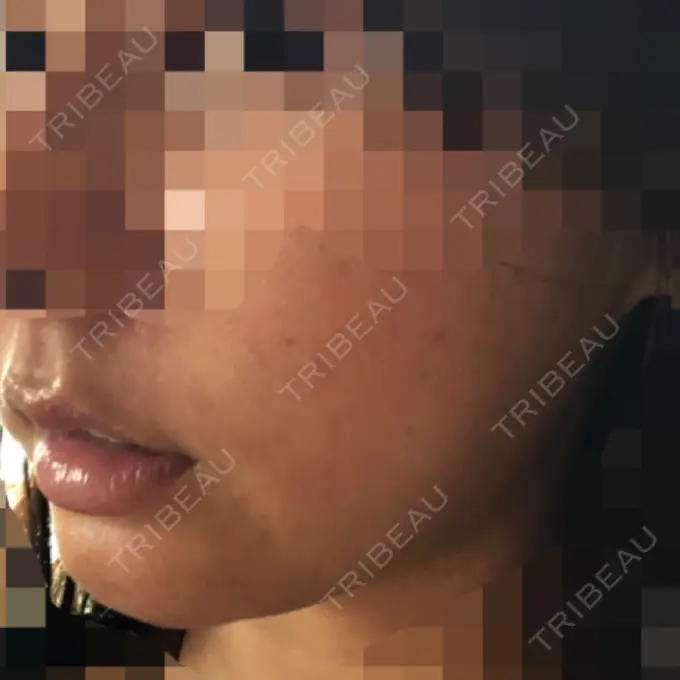 ルフォー+ssro（両あご) / 輪郭修正 ウォンジン（Wonjin）整形外科 DAY 41 メイン用