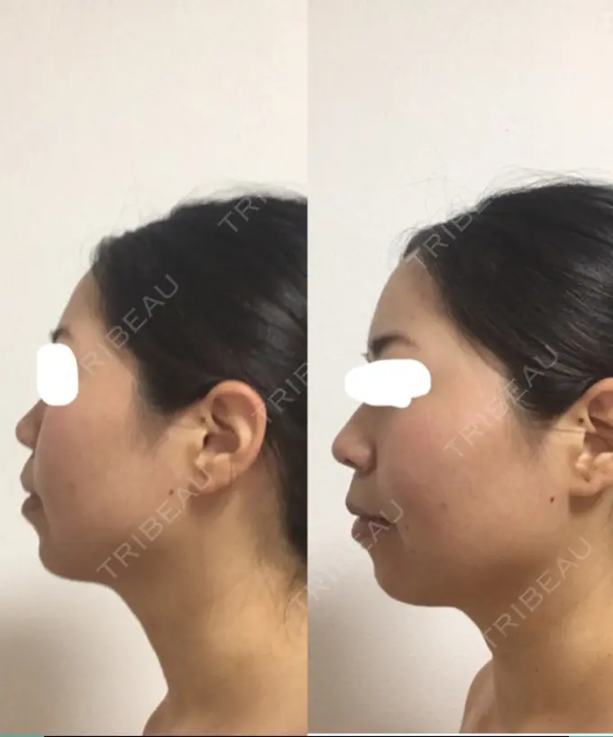 ボトックス（エラ・小顔） Wクリニック 心斎橋院 DAY 3 メイン用