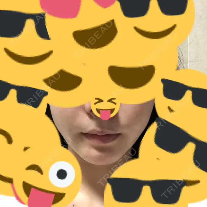 ルフォー+ssro（両あご) / 輪郭修正 ウォンジン（Wonjin）整形外科 DAY 67 メイン用