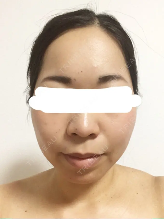 ボトックス（エラ・小顔） Wクリニック 心斎橋院 DAY 3 メイン用